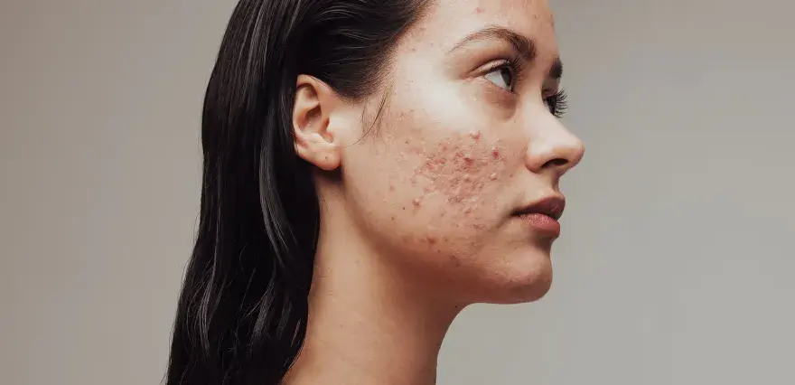 Reine Haut: Effektive Tipps gegen unreine Gesichtshaut & Pickel