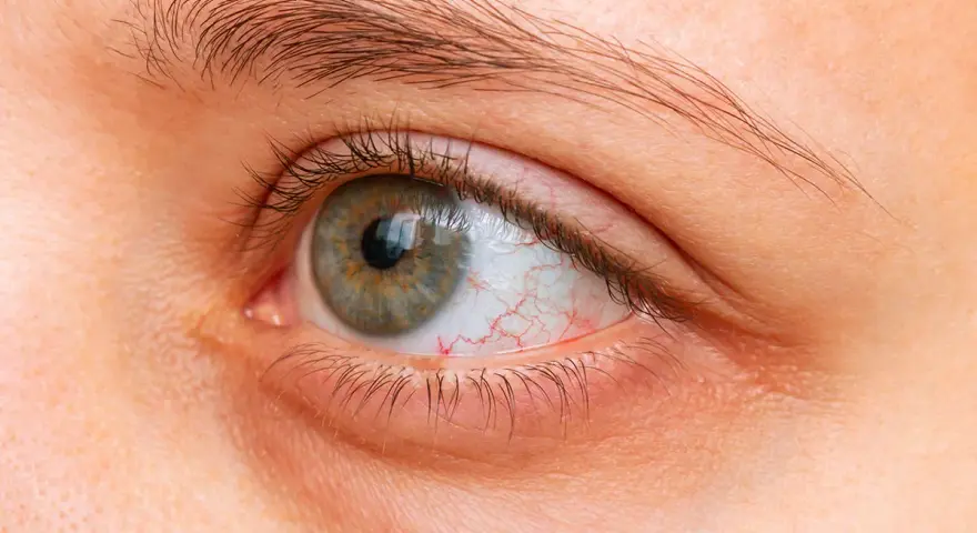 Occhi secchi di notte, con la sclera arrossata e capillari visibili. La palpebra inferiore appare leggermente gonfia.
