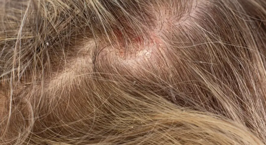 Nahaufnahme der Kopfhaut mit deutlichen Anzeichen von schuppen oder trockene kopfhaut, die sich zwischen den Haaren abzeichnen.