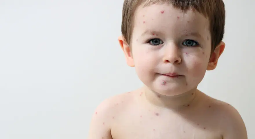 Bambino di 2 anni con puntini rossi intorno alla bocca e sul corpo, forse varicella.