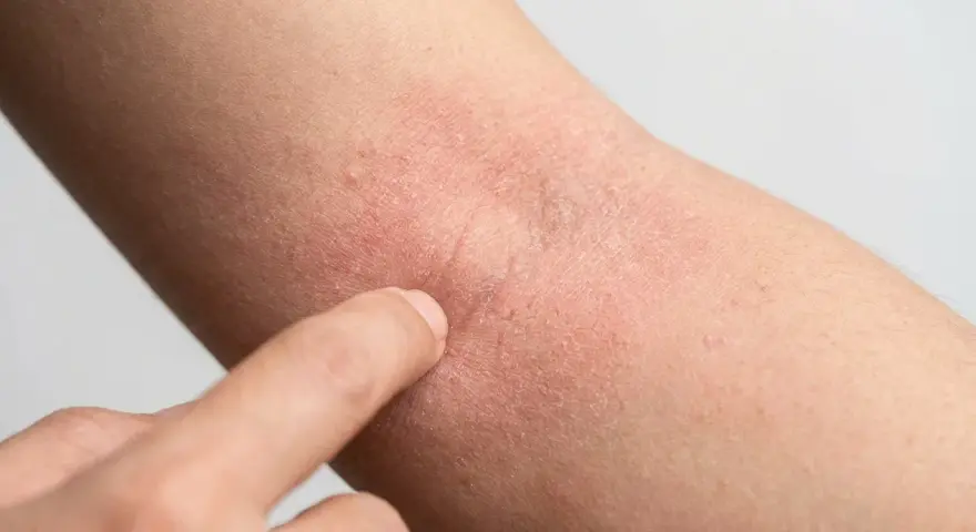 Rote, trockene Haut am Arm, die auf Neurodermitis hindeutet. Eine Hand berührt die betroffene Stelle, um zu zeigen, was hilft gegen Neurodermitis.