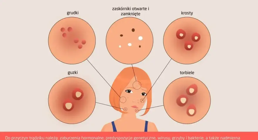Ilustracja przedstawia różne rodzaje krost na twarzy: grudki, guzki, zaskórniki, krosty i torbiele.