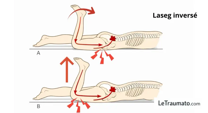 Lasegue inversé : mouvements à éviter pour la cruralgie. Le mouvement A accentue la douleur, le mouvement B est plus doux.