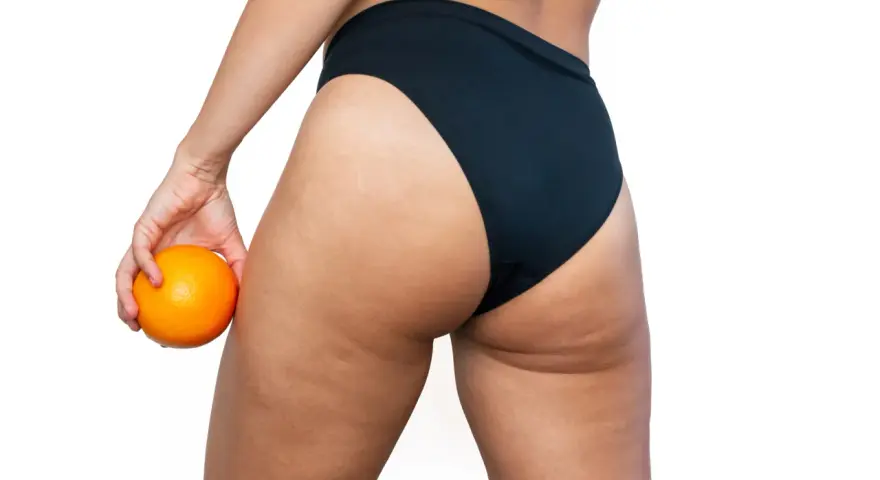 Mujer con naranja en mano, mostrando sus piernas y glúteos con celulitis. ¿Buscas como quitar celulitis piernas?