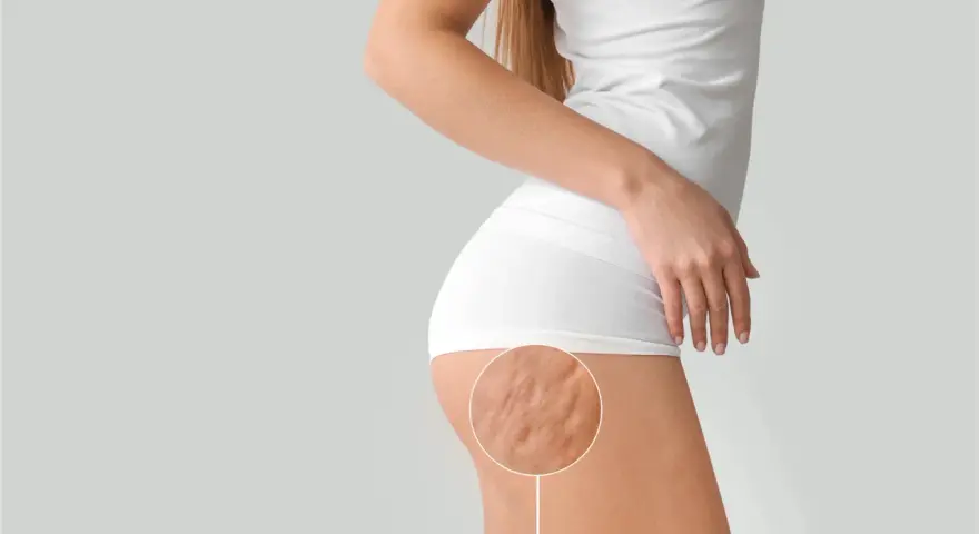 Nahaufnahme der Cellulite am Oberschenkel einer Frau. Hier wird gezeigt, was hilft gegen Cellulite.