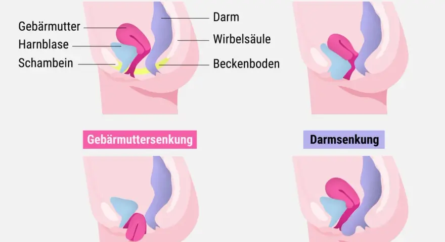 Schematische Darstellung des Beckenbodens: Normale Lage, Blasensenkung, Gebärmuttersenkung und Darmsenksung nach der Geburt.