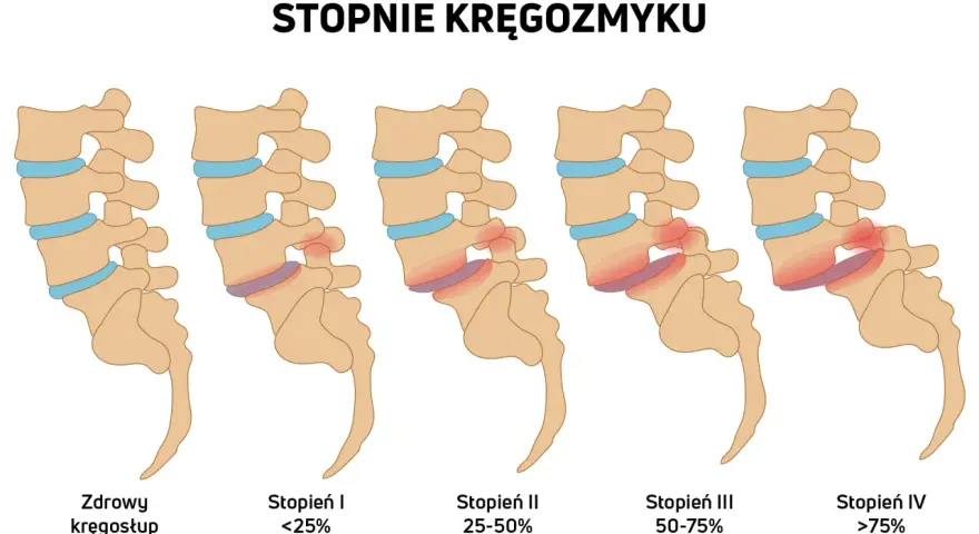 Ilustracja pokazuje stopnie kręgozmyku od zdrowego kręgosłupa do zaawansowanych stadiów, gdzie kręgi przesuwają się względem siebie.