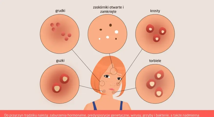 Ilustracja przedstawia różne rodzaje trądziku na skórze: grudki, zaskórniki, krosty, guzki i torbiele.