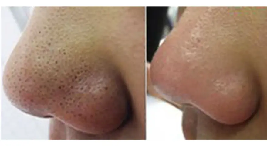 Nariz con puntos negros antes y después de un tratamiento para como quitar los puntos negro de la nariz.