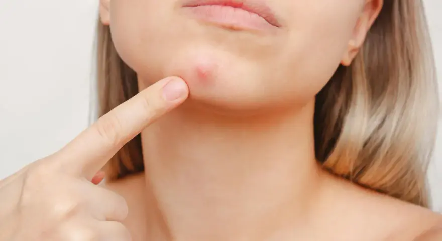 Ein Finger zeigt auf einen roten Pickel am Kinn. Vielleicht hilft eine Zugsalbe, diesen lästigen Pickel schnell verschwinden zu lassen.