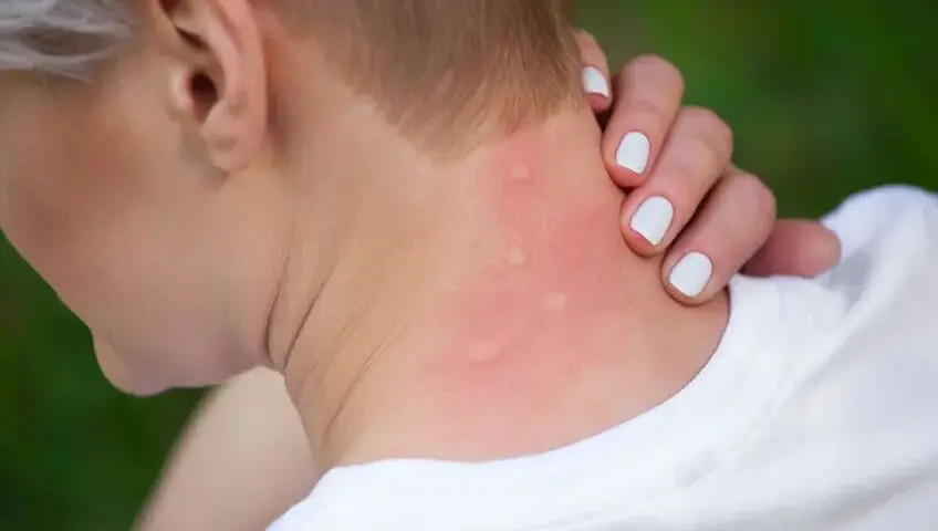 Jak wygląda alergia skórna zdjęcia - poznaj objawy i ich wygląd