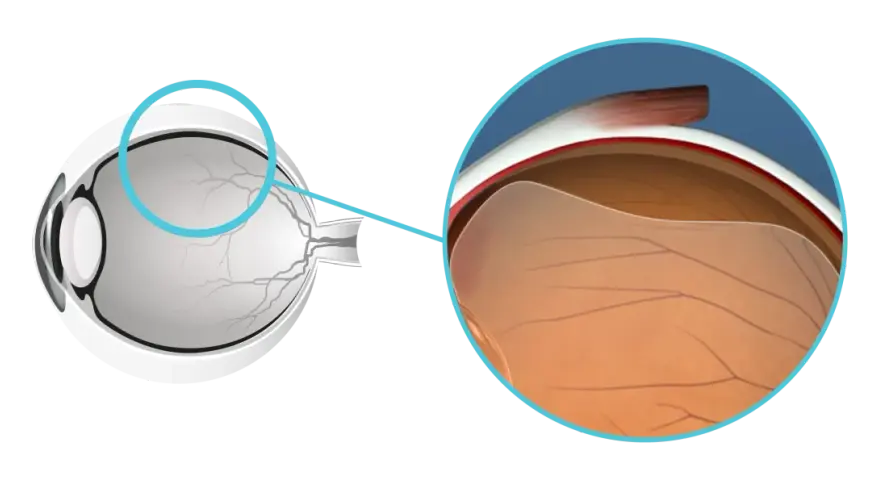 Illustrazione anatomica dell'occhio che mostra il distacco posteriore di vitreo, cosa significa questa condizione.
