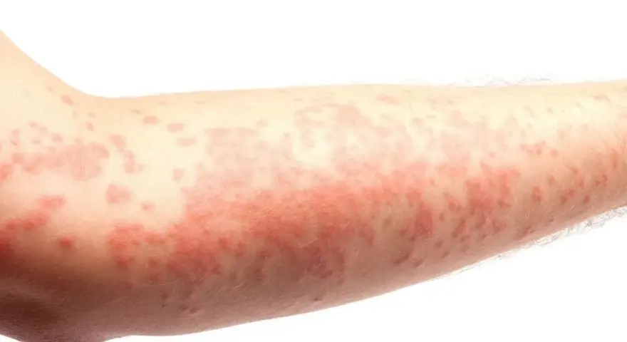 Alergia na sierść: objawy skórne, które mogą zaskoczyć każdego