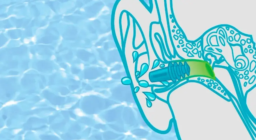 Illustration zeigt ein Kind, das Wasser im Ohr hat. Ein Stöpsel schützt das Ohr vor weiterer Flüssigkeit.
