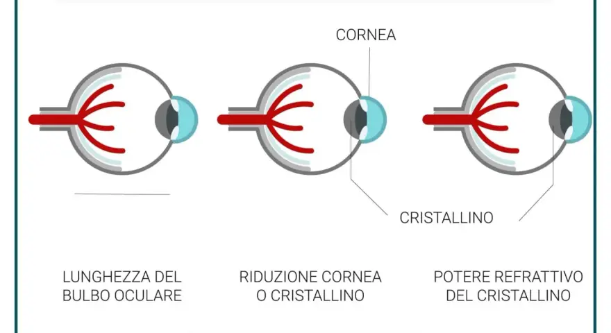 Illustrazione delle cause dell'ipermetropia: bulbo oculare corto, cornea o cristallino ridotti, o potere refrattivo del cristallino.
