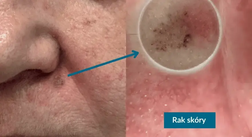 Niepokojący pieprzyk na nosie, powiększony dermatoskopem, ujawnia zmiany sugerujące raka skóry.
