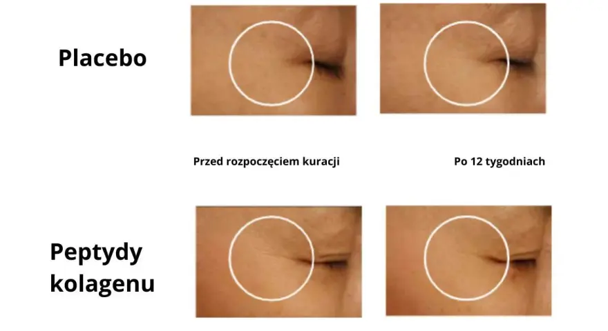 Porównanie efektów kolagenu do picia: skóra przed i po 12 tygodniach kuracji. Zmniejszenie zmarszczek wokół oka.
