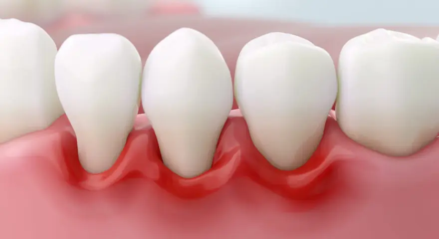 Podrażnione dziąsła: Szybka ulga, leczenie i kiedy do dentysty?