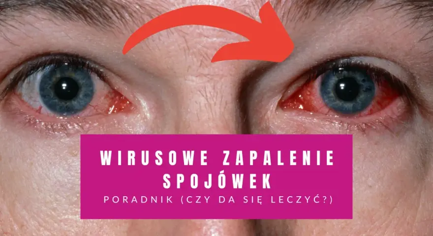 Czerwone, podrażnione oczy z czerwoną strzałką wskazującą na zapalenie. Poradnik: wirusowe zapalenie spojówek - jaki lek na zapalenie spojówek?