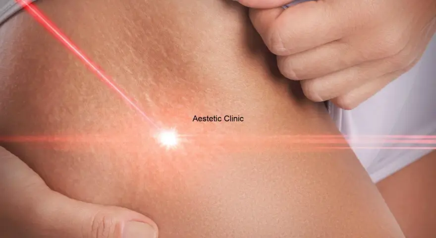 Czerwony promień lasera skierowany na rozstępy na biodrach, symbolizujący zabieg estetyczny.