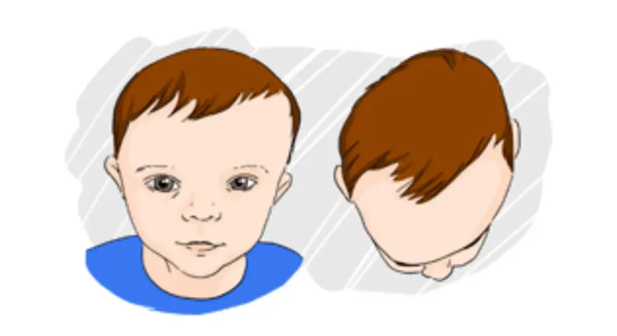 Ilustracja pokazuje niemowlaka z asymetrią główki, co może wskazywać na plagiocefalię.