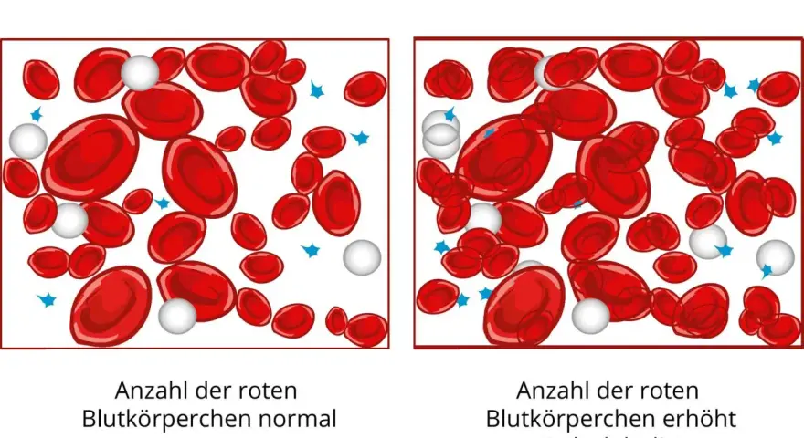 Vergleich von roten Blutkörperchen: Links normal, rechts erhöht (erythrozyten zu hoch). Polyglobulie durch Sauerstoffmangel.