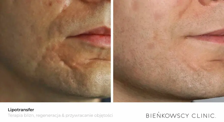 Przed i po lipotransferze twarzy: widoczna redukcja blizn i poprawa objętości skóry.