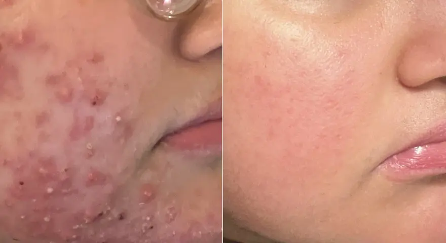 Före- och efterbilder visar en ansiktshud med atopiskt eksem som blivit betydligt bättre.
