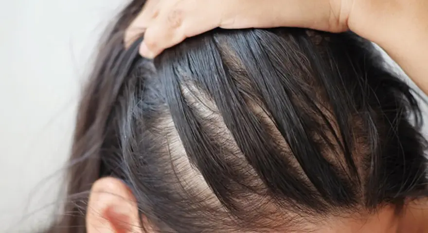 Nahaufnahme der Kopfhaut einer Person, die sich kratzt. Möglicherweise ein Anzeichen von Neurodermitis Kopfhaut.