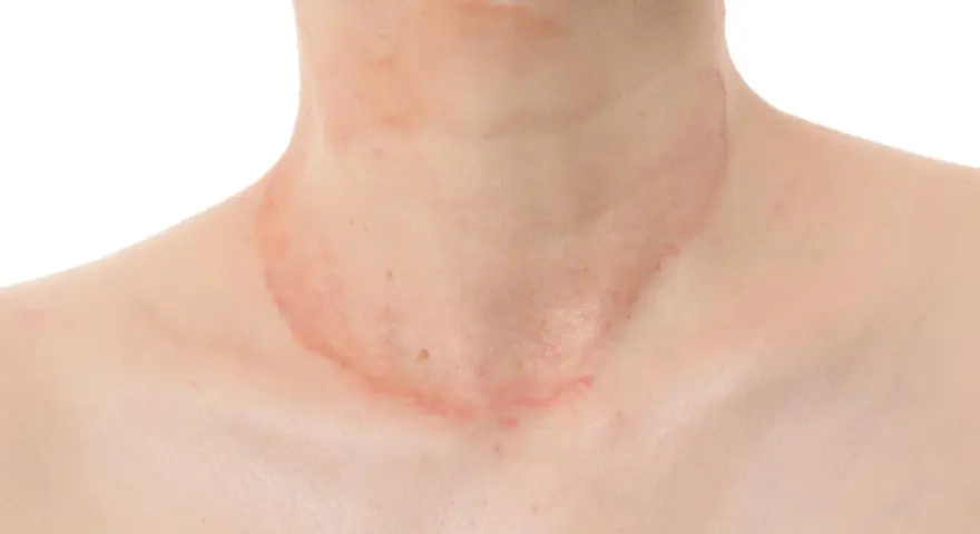 Piel con erupción rojiza y escamosa en el cuello, sugiriendo la presencia de hongos en el cuello.