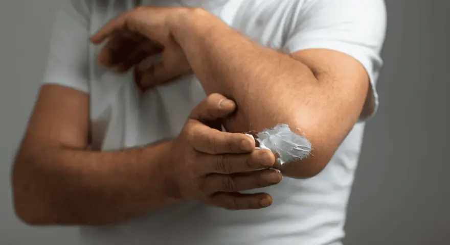Mężczyzna smaruje łokieć kremem. Szukasz najlepszej kliniki leczenia łuszczycy?