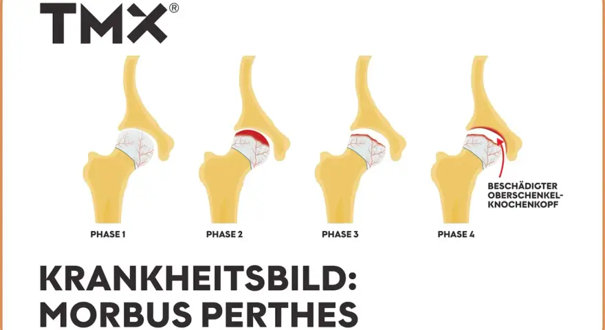 Illustration von 4 Phasen des Morbus Perthes am Hüftgelenk.