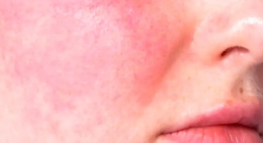 Primo piano di pelle con rosacea, arrossamento diffuso e piccoli vasi sanguigni visibili sulle guance e sul naso.