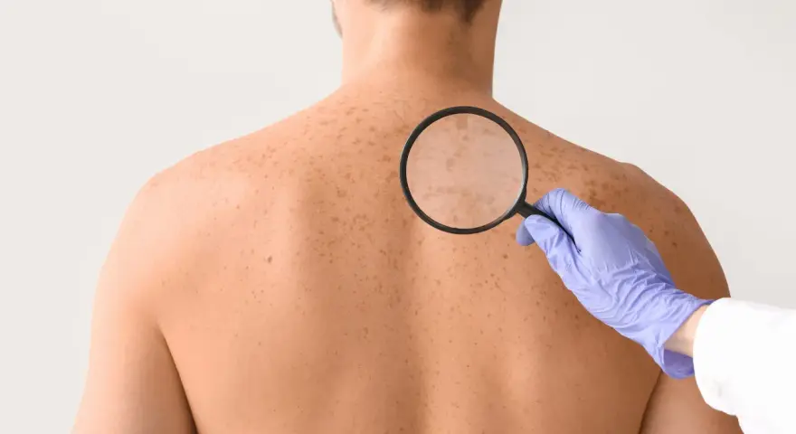 Dermatolog bada plecy pacjenta z licznymi białymi plamami na skórze, używając lupy.