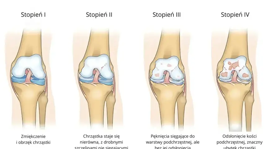 Ilustracja pokazuje cztery stopnie chondromalacji rzepki wg Outerbridge'a: od zmiękczenia chrząstki do odsłonięcia kości.