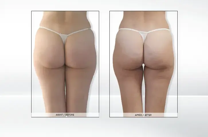 Endermologia: Ile cm stracisz? Realne efekty i wskazówki