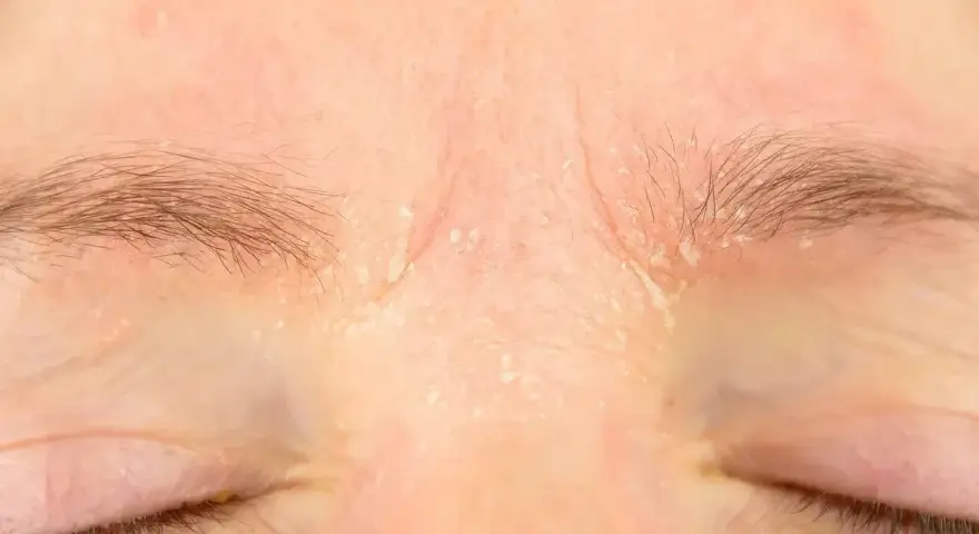 Skóra nad oczami jest zaczerwieniona i łuszczy się, co może być jednym z retinol skutki uboczne.
