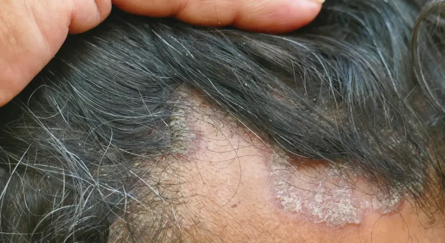 Juckende Kopfhaut mit schuppigen Stellen und Haarausfall. Eine Hand berührt die betroffenen Stellen.