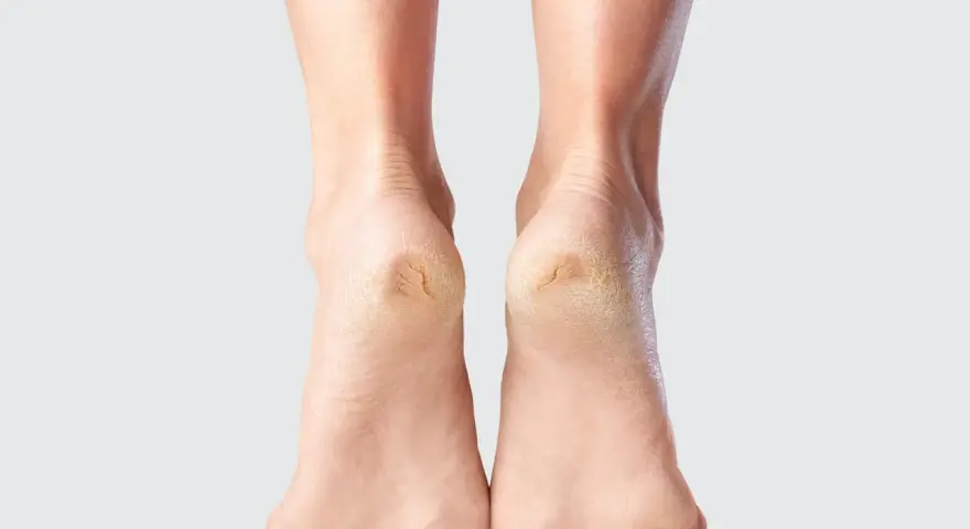 Talons secs et craquelés, un signe qu'il est temps d'envisager un durillon pied traitement naturel pour retrouver douceur et confort.