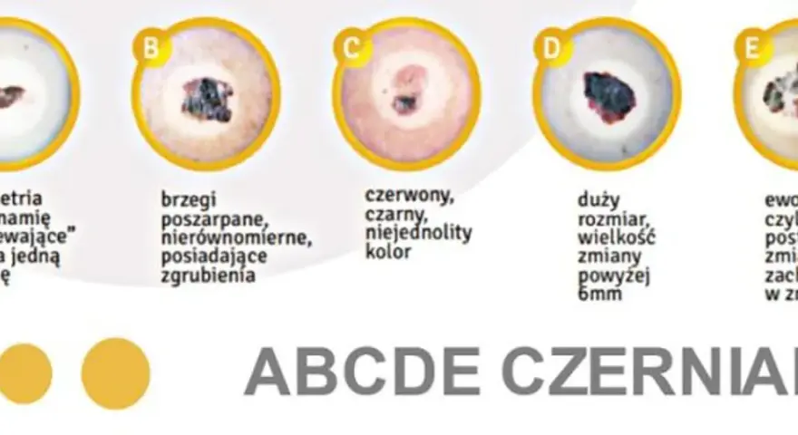 ABCDE czerniaka: asymetria, brzegi, czerwony/czarny kolor, duży rozmiar, ewolucja. Obrazki pokazują, jak wygląda czerniak.