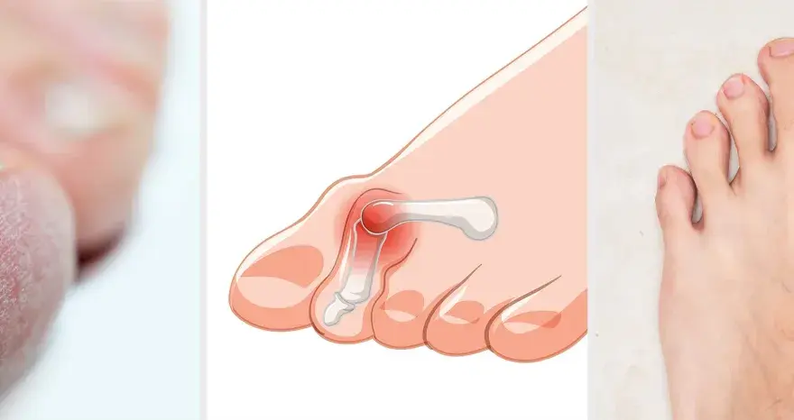 Pie con juanete y uñas afectadas, resultado de usar zapatos estrechos en la parte delantera.