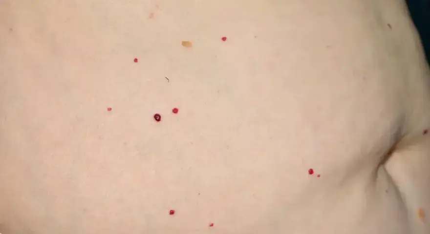 Czerwone pieprzyki na brzuchu, drobne i kilka większych, rozrzucone na jasnej skórze.