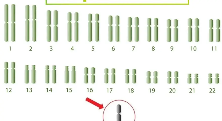 Kariotyp przedstawiający zespół Turnera, z zaznaczonym brakiem jednego chromosomu X (XO).
