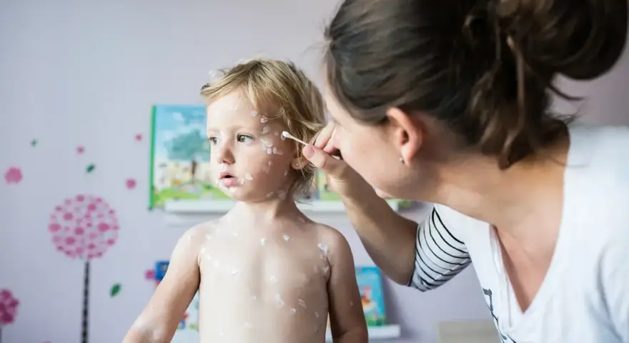Madre aplica crema a su bebé con miliaria. El niño rubio tiene la piel cubierta de pequeñas erupciones blancas.