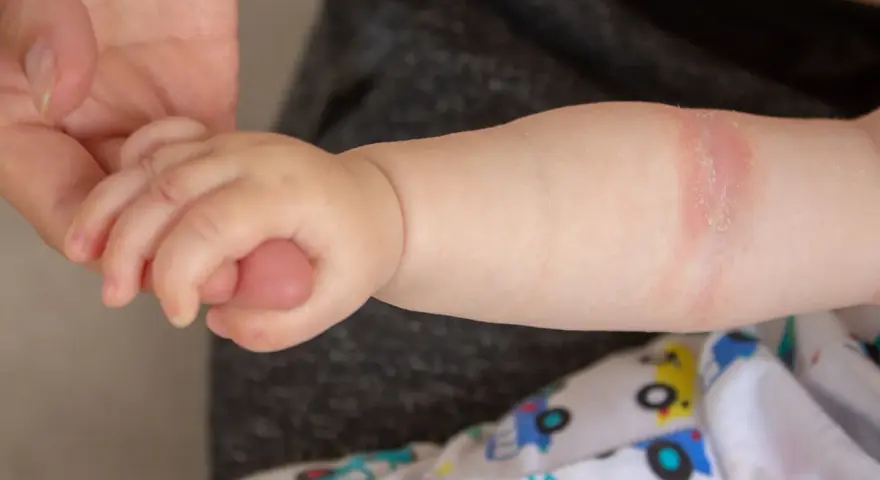 Babyarm mit geröteter Stelle, die auf einen Hautpilz am Po hindeuten könnte.