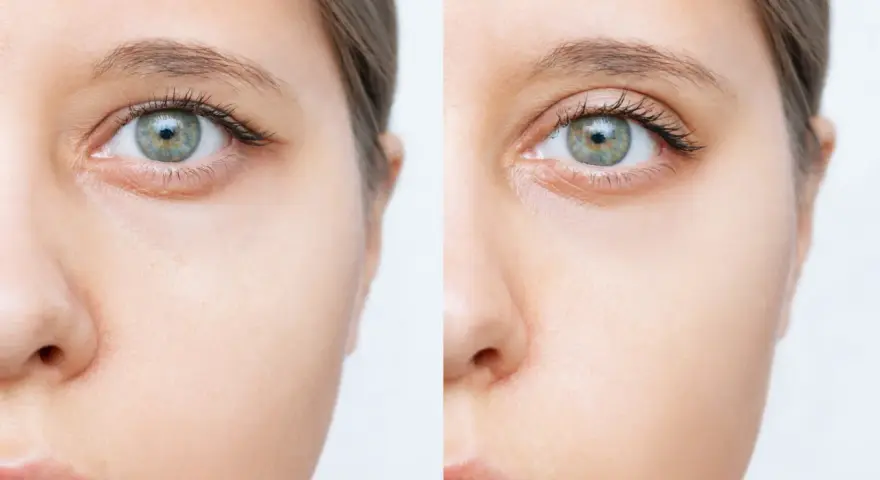Przed i po zabiegu direct brow lift. Widoczne uniesienie brwi, odmłodzenie spojrzenia.