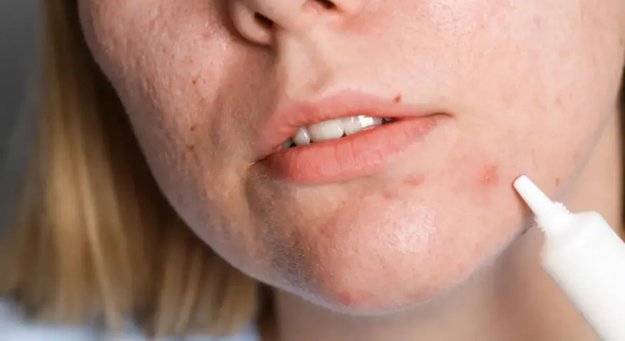 Kobieta aplikuje krem na wyprysk, szukając skutecznych zabiegów na trądzik hormonalny.