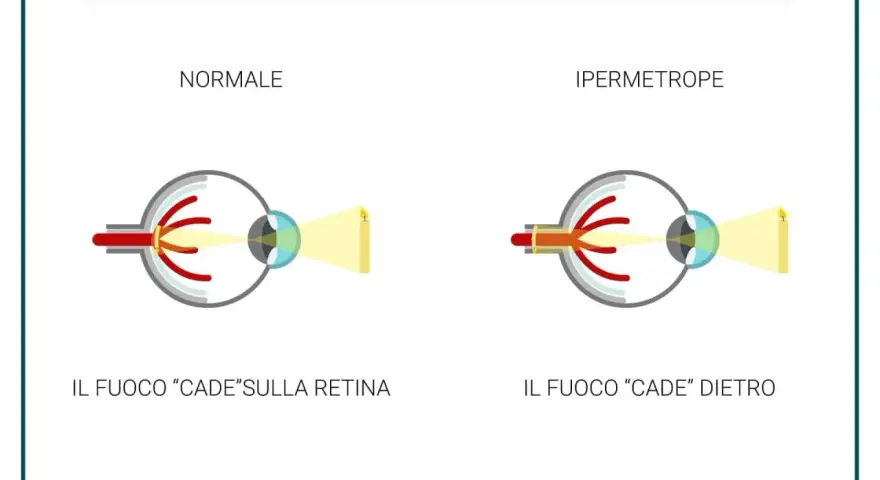 Confronto tra occhio normale e occhio ipermetrope. Nell'ipermetropia lieve, il fuoco cade dietro la retina, rendendo sfocati gli oggetti vicini.
