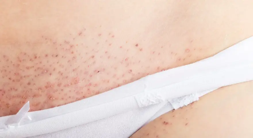 Närbild på irriterad hud efter rakning, med små röda prickar och knottror.