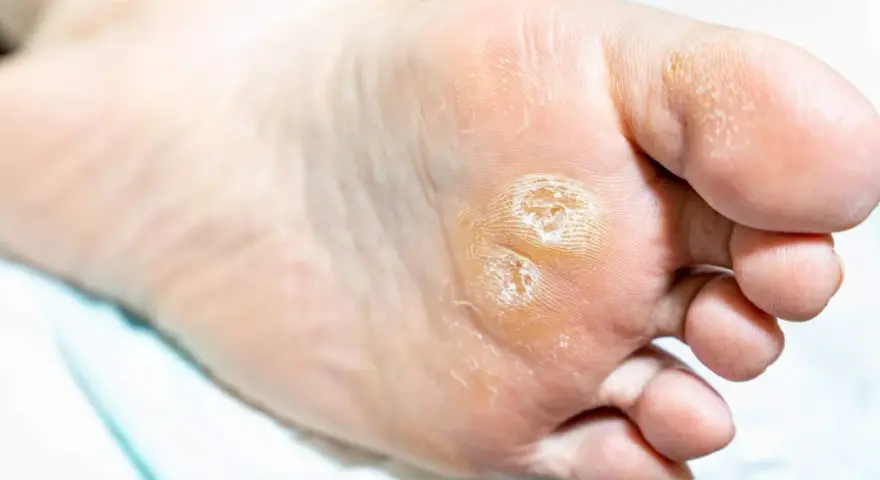 Gros plan sur un pied présentant un cor entre les orteils, avec la peau sèche et craquelée autour.